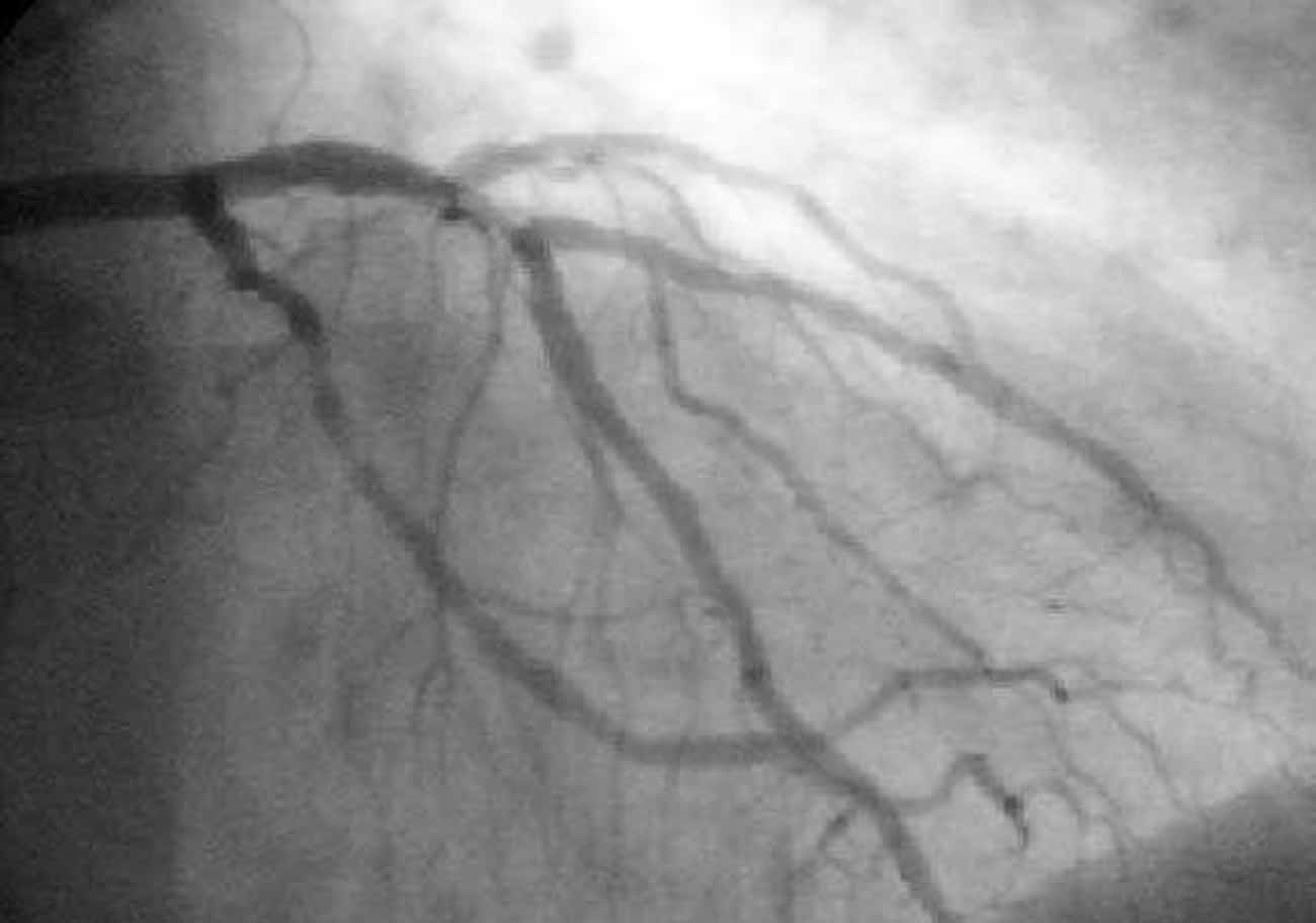 The Coronary Angiogram Came About When A Catheter Slipped While A Cardiologist Was Treating A Patient