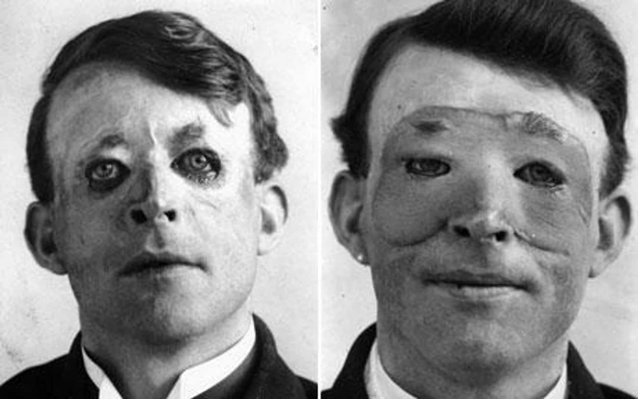 The First Successful Plastic Surgery Helped Wounded Soldiers In WWI