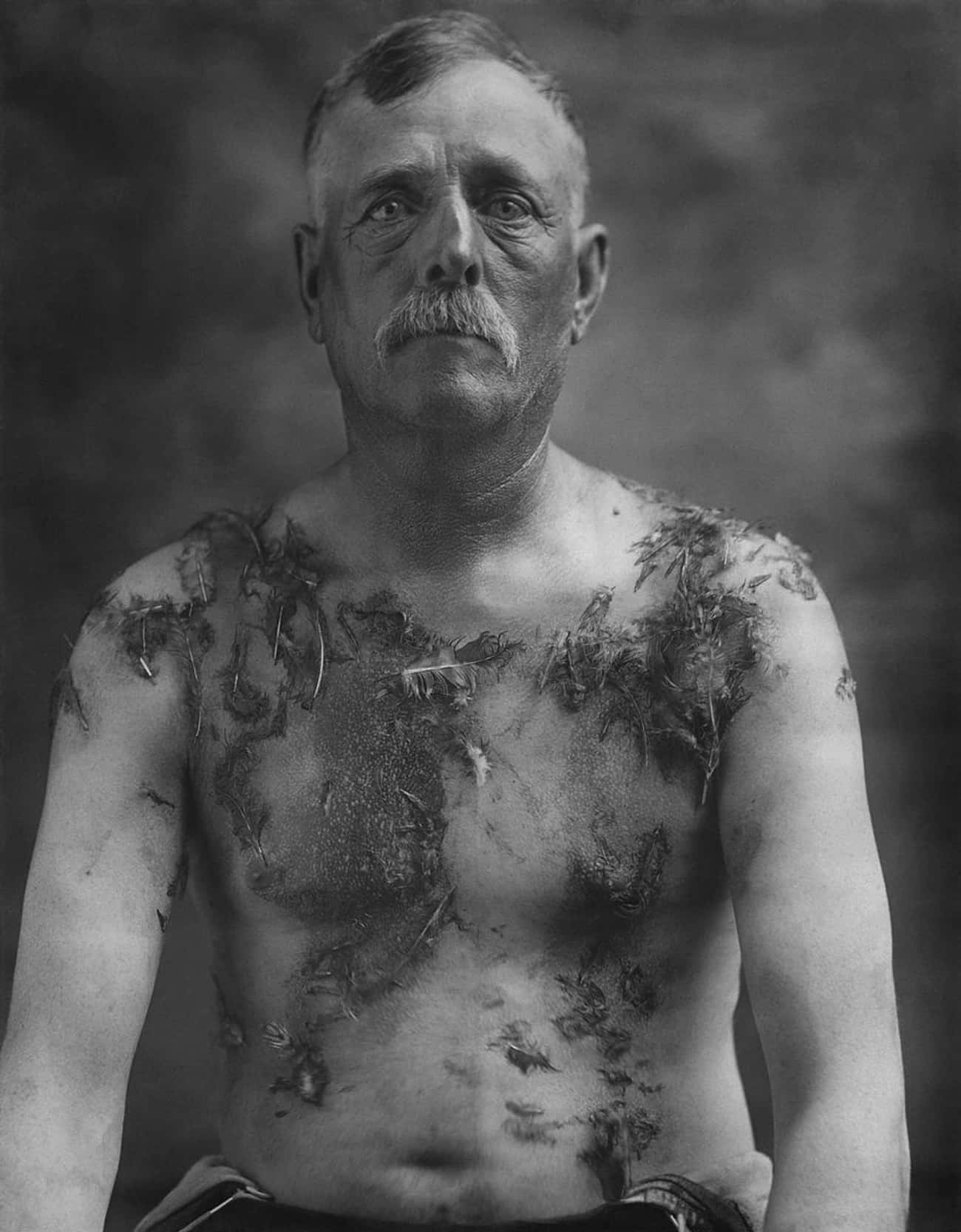 German-American Farmer After Being Tarred And Feathered Amid Anti-German Sentiment In The US During WWI - 1918