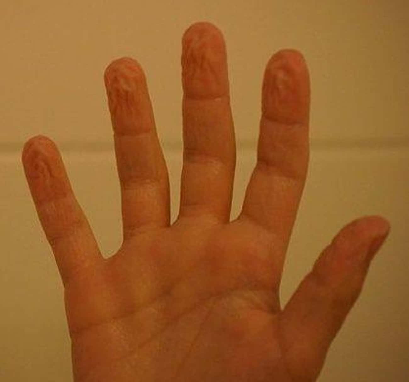 Fingers And Toes Don't Get Wrinkly From Absorbing Water; It's A Nerve Reflex