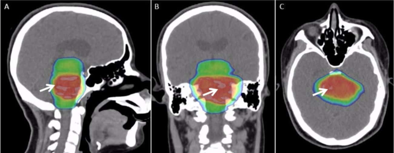 A Man’s Terrible Case Of Hiccups Was Caused By A Tumor