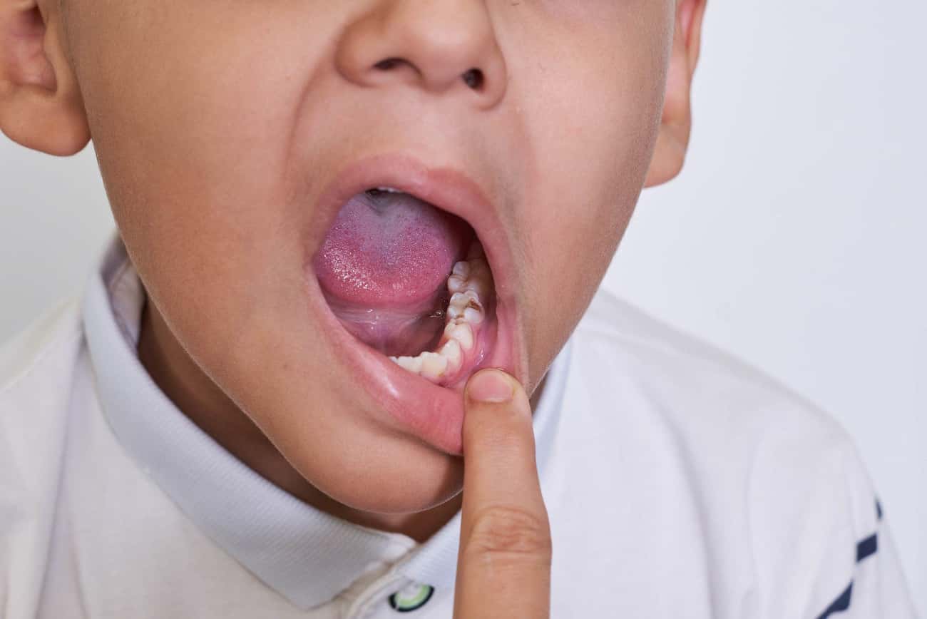 Myth: Candy Causes Tooth Decay