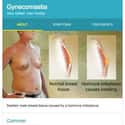 Gynecomastia on Random Weird Medical Drawings Google Thinks You Need