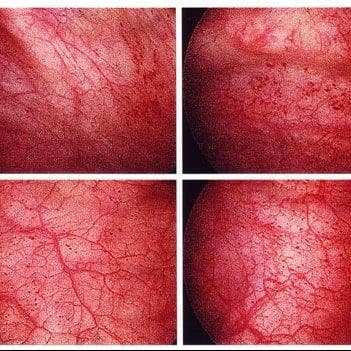 Urinary System Diseases List of Urinary Disorders