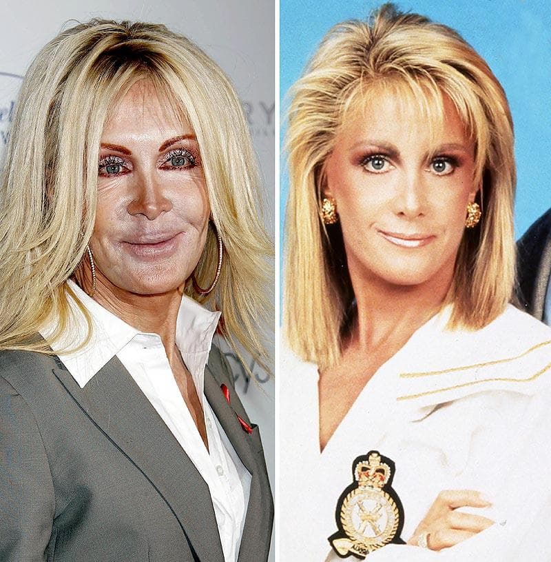 free worst plastic surgery before and after