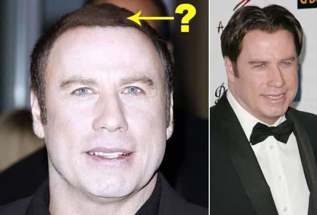 Celebrities Who Have Had Hair Transplants - ViraLuck